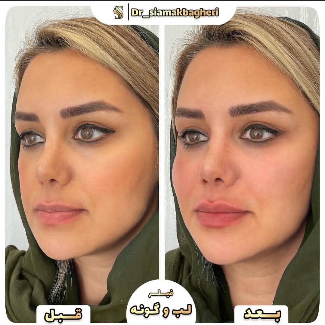 ژل لب و گونه