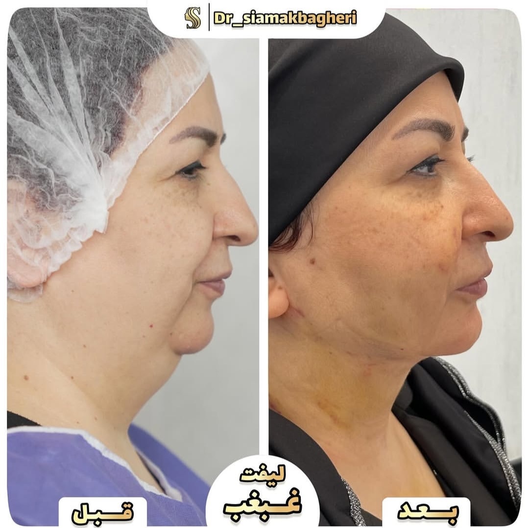 لیفت غبغب