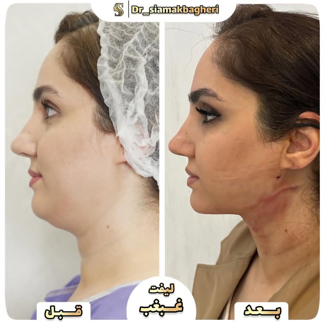 لیفت غبغب