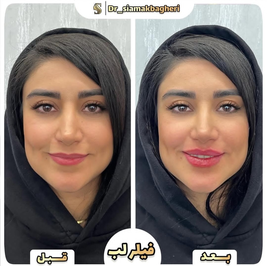 فیلر لب